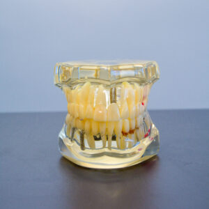 Teeth Alignment.